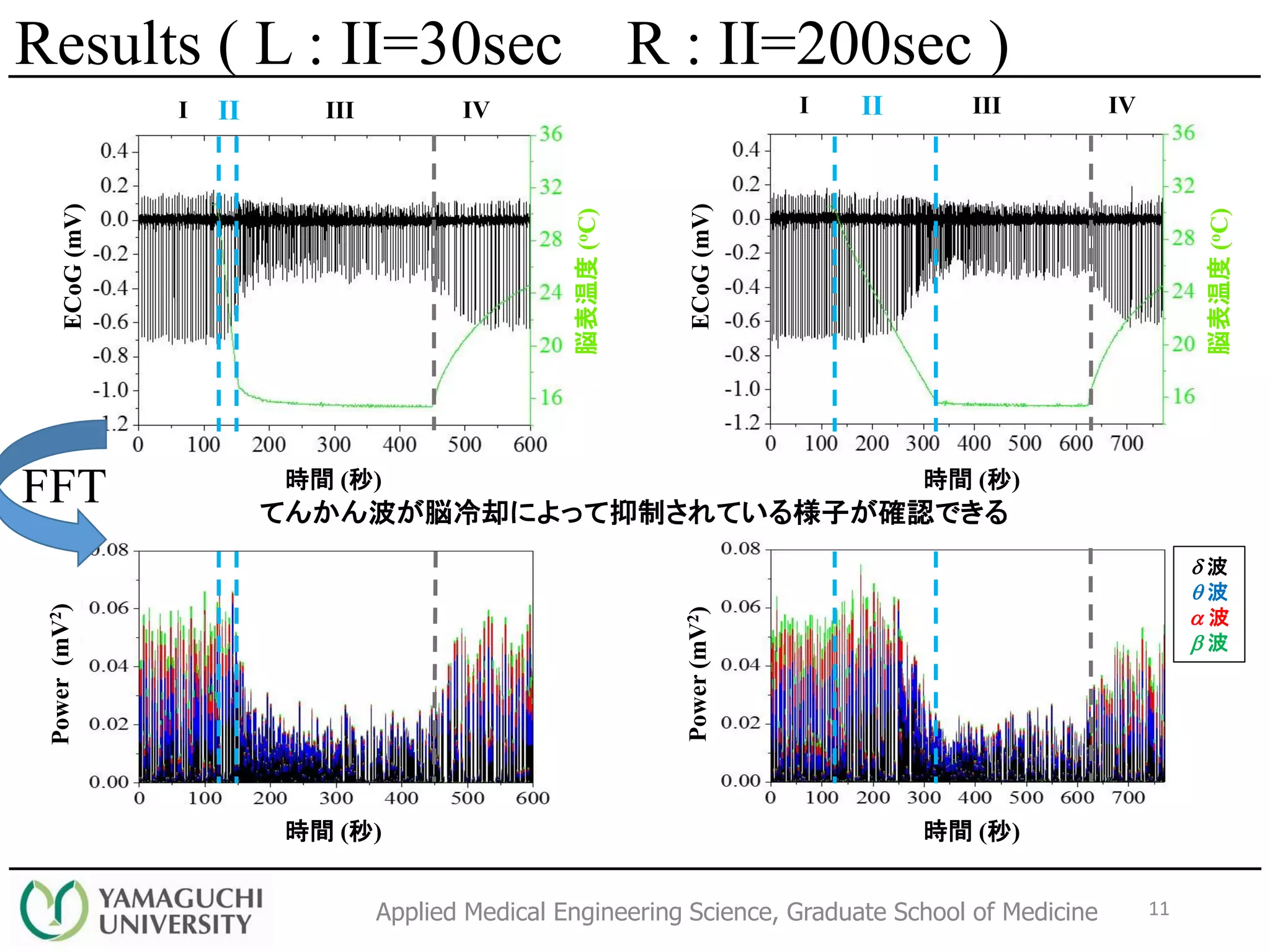Applied Medical Engineering Science, Graduate School of Medicine
I II III IV I II III IV
てんかん波が脳冷却によって抑制されている様子が確認できる
ECoG(mV)
ECoG(mV)
時間 (秒)時間 (秒)
脳表温度(oC)
脳表温度(oC)
d 波
q 波
a 波
b 波
Power(mV2)
Power(mV2)
時間 (秒)時間 (秒)
FFT
11
Results ( L : II=30sec R : II=200sec )
 