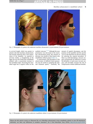in cervical length, which was greater in
patients who had maxillary advancement,
and maxilla impaction due to the autoro-
tation of the mandible. As reported in
previous studies, a straightening of the
upper lip was also found after mandibular
setback, with a concomitant increase in
the nasolabial angle. Increasing the naso-
labial angle has a negative effect on the
aesthetic outcome.22,23
Although the nose
prominence was decreased in the maxil-
lary advancement group, this amount of
decrease was similar to that found in the
mandibular setback group (Table 2).
A consciousness and perception of the
attractiveness of different facial parame-
ters may be useful in compiling the opti-
mal treatment option.23
Generally, the
amount of sagittal discrepancy and the
position of the mandible and the maxilla
vis-a`-vis the skull base are decisive factors
for selecting the surgical procedure. If
there is a small discrepancy, one-jaw sur-
gery will generally be sufﬁcient to correct
the deformity; in such cases, two-jaw sur-
gery will inevitably increase the risk of
complications without additional beneﬁts.
Maxillary advancement vs. mandibular setback 5
YIJOM-3562; No of Pages 7
Please cite this article in press as: Ghassemi M, et al. Maxillary advancement versus mandibular setback in class III dentofacial
deformity: are there any differences in aesthetic outcomes?, Int J Oral Maxillofac Surg (2016), http://dx.doi.org/10.1016/
Fig. 2. Photographs of a patient who underwent maxillary advancement: (a) pre-treatment, (b) post-treatment.
Fig. 3. Photographs of a patient who underwent mandibular setback: (a) pre-treatment, (b) post-treatment.
 