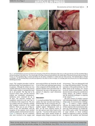 years). The complete procedure could be
performed under local anaesthesia in sev-
en patients. Although the defect size was
variable following excision of the tumour
with a safety margin, it included the nasal
ala in all patients. The ﬂap had to be
revised in three cases, and this resolved
without any remarkable consequences.
Antibiotics were continued for up to
10 days. The auricular cartilage was
completely removed in one case, due to
an infection of the surgical site. The area
was grafted with new auricular cartilage
after complete resolution of the wound
infection. There was no case of ﬂap ne-
crosis or loss. All individuals, with the
exception of two patients, were satisﬁed
with the aesthetic and functional outcomes
(Table 2). However, the two examiners
who were involved in the surgery and
post-surgical follow-up, found the ala still
to be too thick and requiring improvement
when compared with the healthy side. All
patients reported some discomfort due to
obstruction, but none of the patients com-
plained of subjective nasal obstruction
after 1 year.
Discussion
A reversed nasolabial ﬂap was utilized to
replace the inner mucosal nasal lining, a
forehead ﬂap for the overlying skin cov-
erage, and an auricular cartilage graft as
skeletal support. Malignancies such as
BCC are the most common tumour of
the skin and are most often found on the
nasal ala.1,2
Excision of the tumour of the
affected nasal region should include an
adequate safety margin to reduce the rate
of recurrence.3
This can subsequently lead
to a large full-thickness defect. The surgi-
cal choice of the preferred donor site will
differ based on the location, size, tissues
involved, medical comorbidities, and the
desired outcome, taking into consideration
airway patency, the aesthetic outcome,
and the preferred technique or expertise
of the surgeon.10,12
The nose consists of complex contours
with alternating shadows and highlights,
which make its reconstruction challeng-
ing.10–12
To achieve a better aesthetic
outcome, the surgeon should consider all
of these aspects in the reconstruction plan,
since any small deformity or residual de-
fect will be easily visible. The principles
of nasal subunits in facial aesthetics
should be respected as much as possible
to improve the aesthetic and functional
Reconstruction of lower third nasal defects 3
YIJOM-3515; No of Pages 5
Please cite this article in press as: Ghassemi A, et al. Three-layer reconstruction of lower third nasal defects using forehead ﬂap,
reversed nasolabial ﬂap, and auricular cartilage, Int J Oral Maxillofac Surg (2016), http://dx.doi.org/10.1016/j.ijom.2016.08.024
Fig. 2. (a) Full-thickness excision of a basal cell carcinoma of the left lower third part of the nose in a 60-year-old man. (b) The nasolabial ﬂap is
incised according to the defect size. The cranial edge of the ﬂap is dissected and sutured to the caudal edge of the preserved nasal mucosa using 4–0
Vicryl. (c) The nasolabial ﬂap is sutured and ﬁtted into the defect completely to replace the lost nasal mucosa. The forehead ﬂap is marked
accordingly. (d) The forehead ﬂap is elevated and adjusted to the defect as skin coverage. (e) Cartilage graft seen between the two ﬂaps during the
debulking procedure.
 