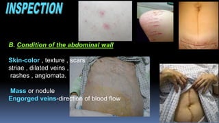 B. Condition of the abdominal wall
Skin-color , texture , scars ,
striae , dilated veins ,
rashes , angiomata.
Mass or nodule
Engorged veins-direction of blood flow
 