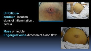 Umbilicus-
contour , location ,
signs of inflammation ,
hernia
Mass or nodule
Engorged veins-direction of blood flow
 