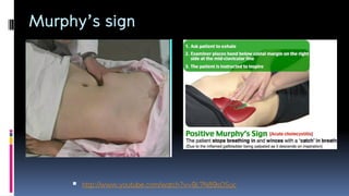 Murphy’s sign
 http://www.youtube.com/watch?v=9L7N89sOSuc
 