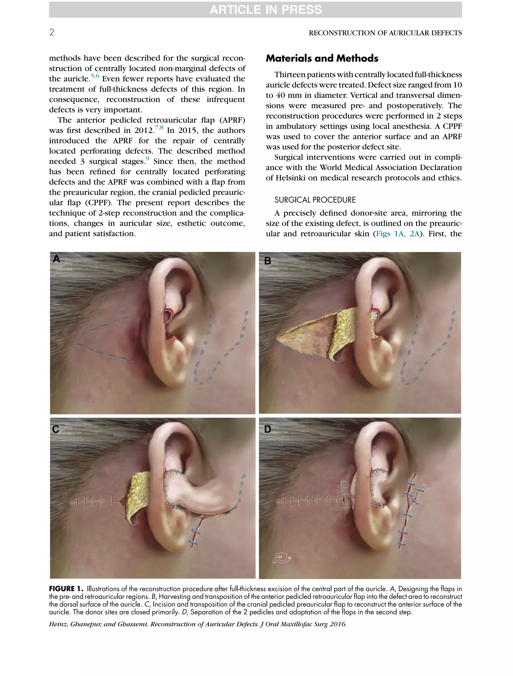 Preauricular Incision Steps 2016 heinz-two-step reconstruction of non-marginal auricular defects | PDF