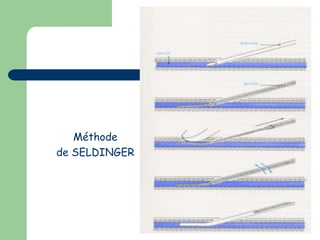 Méthode
de SELDINGER
 