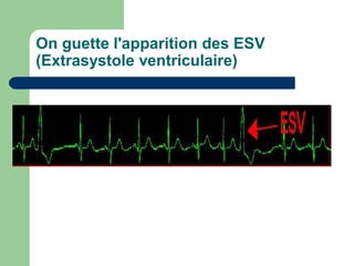 On guette l'apparition des ESV
(Extrasystole ventriculaire)
 