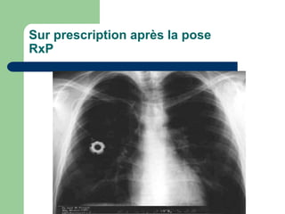 Sur prescription après la pose
RxP
 