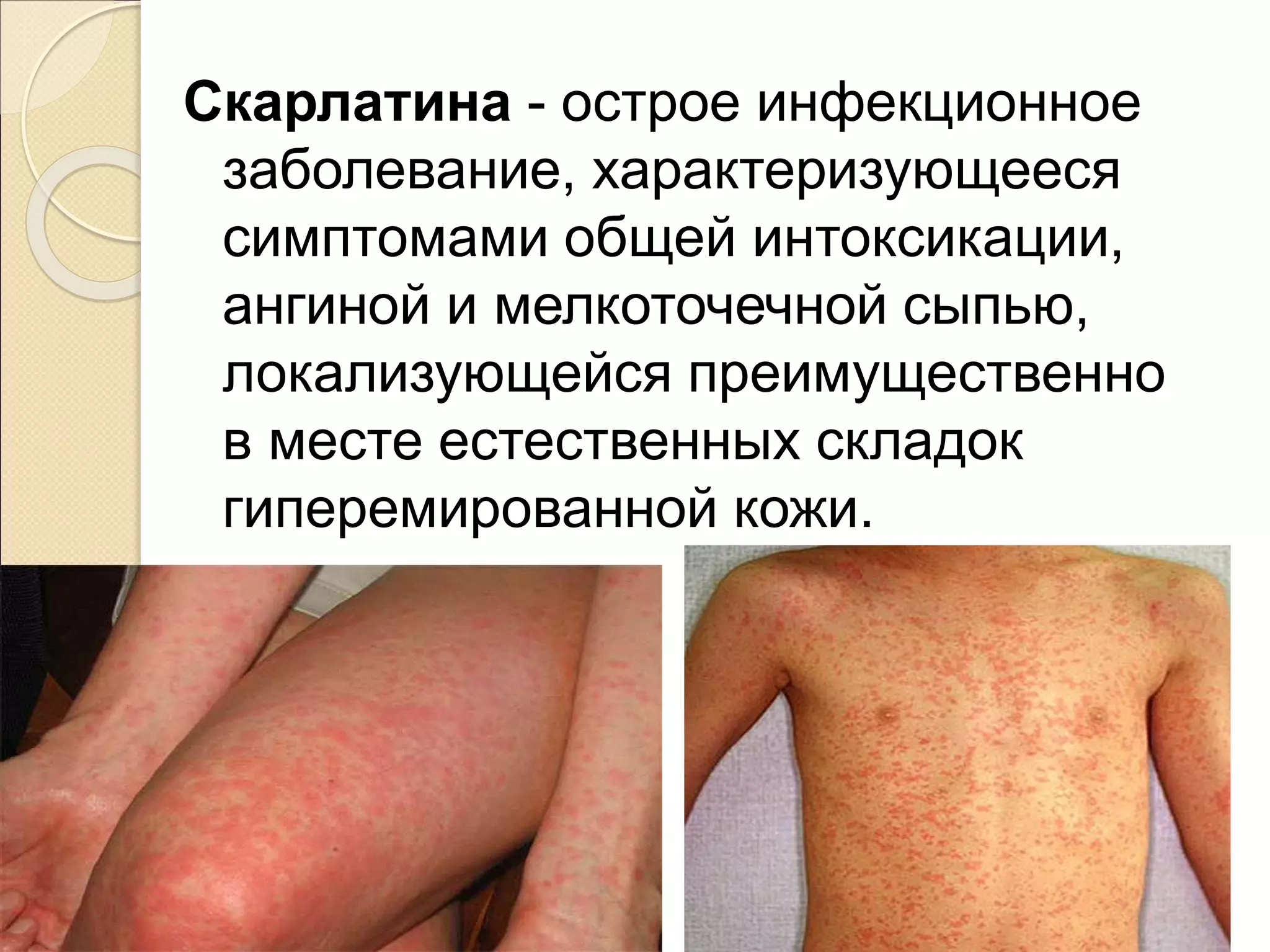 Скарлатина - острое инфекционное
заболевание, характеризующееся
симптомами общей интоксикации,
ангиной и мелкоточечной сыпью,
локализующейся преимущественно
в месте естественных складок
гиперемированной кожи.
 