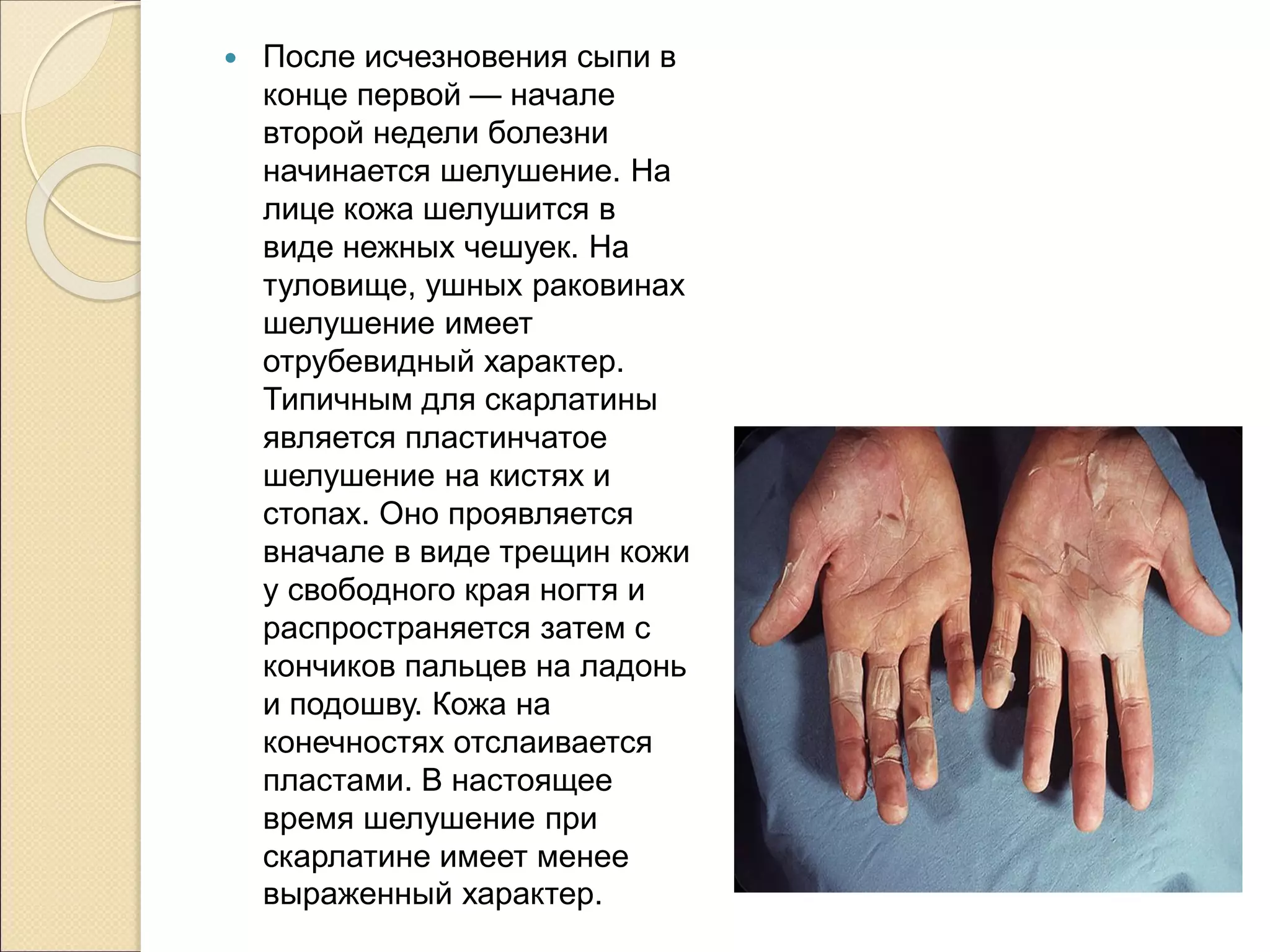  После исчезновения сыпи в
конце первой — начале
второй недели болезни
начинается шелушение. На
лице кожа шелушится в
виде нежных чешуек. На
туловище, ушных раковинах
шелушение имеет
отрубевидный характер.
Типичным для скарлатины
является пластинчатое
шелушение на кистях и
стопах. Оно проявляется
вначале в виде трещин кожи
у свободного края ногтя и
распространяется затем с
кончиков пальцев на ладонь
и подошву. Кожа на
конечностях отслаивается
пластами. В настоящее
время шелушение при
скарлатине имеет менее
выраженный характер.
 