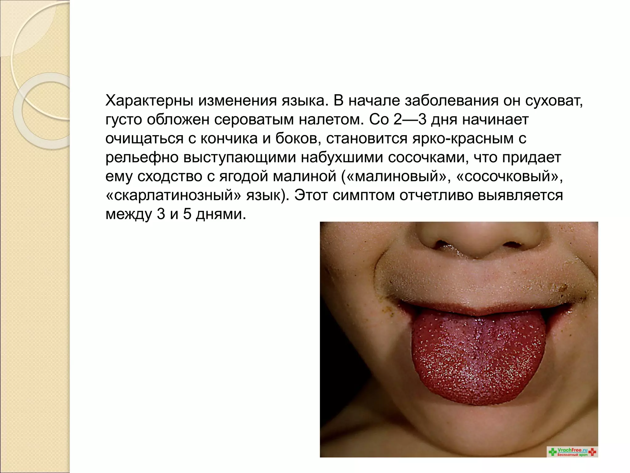 Характерны изменения языка. В начале заболевания он суховат,
густо обложен сероватым налетом. Со 2—3 дня начинает
очищаться с кончика и боков, становится ярко-красным с
рельефно выступающими набухшими сосочками, что придает
ему сходство с ягодой малиной («малиновый», «сосочковый»,
«скарлатинозный» язык). Этот симптом отчетливо выявляется
между 3 и 5 днями.
 