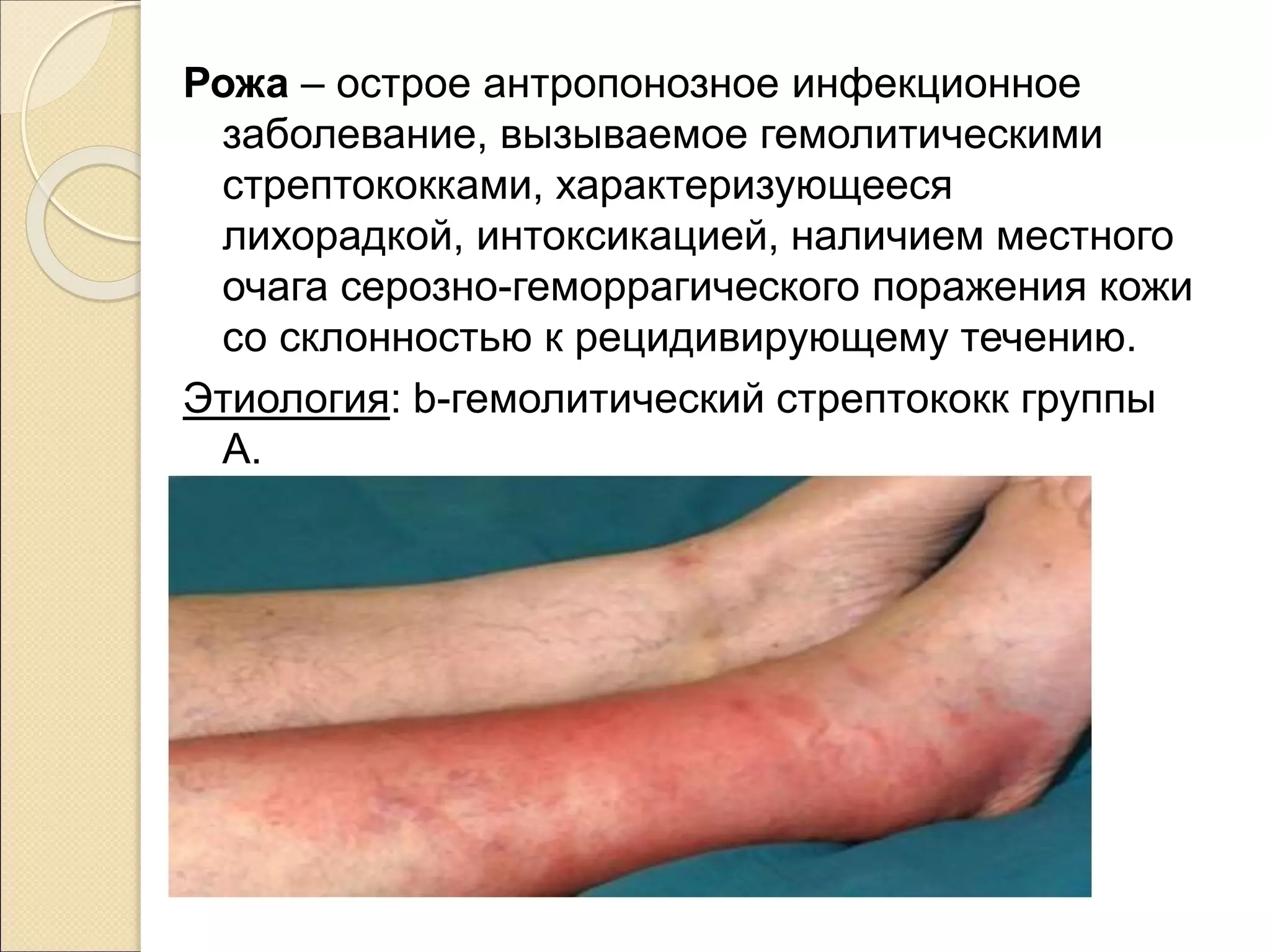 Рожа – острое антропонозное инфекционное
заболевание, вызываемое гемолитическими
стрептококками, характеризующееся
лихорадкой, интоксикацией, наличием местного
очага серозно-геморрагического поражения кожи
со склонностью к рецидивирующему течению.
Этиология: b-гемолитический стрептококк группы
А.
 
