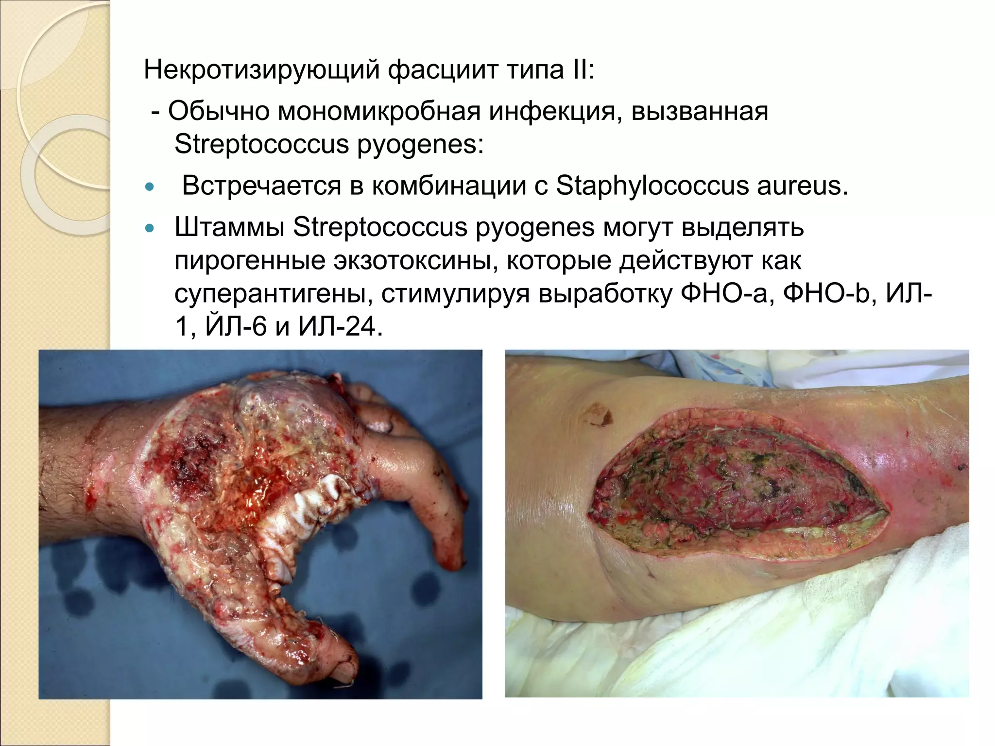 Некротизирующий фасциит типа II:
- Обычно мономикробная инфекция, вызванная
Streptococcus pyogenes:
 Встречается в комбинации с Staphylococcus aureus.
 Штаммы Streptococcus pyogenes могут выделять
пирогенные экзотоксины, которые действуют как
суперантигены, стимулируя выработку ФНО-а, ФНО-b, ИЛ-
1, ЙЛ-6 и ИЛ-24.
 