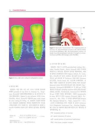26 I Scientific Evidence 27IMPLANT I
DISCUSSION
This study demonstrated that 2 variables af-
fect the primary stability of implants: location
(monocortical block or bicortical block) and
preparation method (standard preparation, and
underpreparation or the osteotome technique).
The correlation between biomechanical testing
(insertion and removal torque) and RFA were
also evaluated. The results lead to a rejection of
the first null hypothesis that location and prep-
aration method do not affect the primary sta-
bility of implants; the second hypothesis that
there was no correlation between the values of
insertion and removal torque and RFA was also
rejected.
Primary stability is the result of mechanical
engagement with the surrounding bone tis-
sue and can be distinguished from secondary
or biological stability by the presence of bone
regeneration and remodeling in the latter. In
addition, primary stability, rather than second-
ary stability, is a critical factor when immediate
loading is considered because it develops within
1 week of implantation. For immediate loading,
single implants must be inserted with a torque
greater than or equal to 30 Ncm, and splinted
implants with a torque greater than or equal
to 20 Ncm.5
In the present study, the insertion
torque exceeded 30 Ncm in all groups. These
values are higher than those reported by Nken-
ke et al,26
who measured insertion torque in the
posterior maxillary region of human cadavers.
These findings suggest that measured insertion
torque in polyurethane specimens is higher
than that in the posterior maxillary region in
humans, even though the mean density was
similar. In addition, for all the groups in this
study, the mean values of removal torque were
lower than the mean values of insertion torque.
This can be explained by the restricted vis-
coelastic properties of the surrounding artificial
bone, resulting in less resistance during remov-
al. These findings are in agreement with other
recently published data using polyurethane
foam blocks in which removal torques were
lower than insertion torques;36
similar observa-
tions have been made in animal studies.37,38
The preparation method had a significant
effect on insertion torque, RFA values, and re-
moval torque. The underpreparation method
had a significant effect on insertion torque com-
pared to standard preparation and the osteot-
ome technique in either monocortical or bicorti-
cal blocks. However, the standard preparation
method had a more significant effect on RFA
values than the underpreparation method in
bicortical blocks, and for removal torque values,
there was no difference between the standard
preparation and underpreparation method.
These findings are somewhat different from
those of another recent study on the influence
of surgical technique and surface roughness on
the primary stability of implants in artificial
bone with a density equivalent to maxillary
bone.23
The authors found that both the inser-
tion and removal torque values obtained with
the undersized technique were higher than
with the press-fit technique. Perhaps these dif-
ferences were due to the presence of the corti-
cal portion of the synthetic bone models of the
present study. Tabassum et al,36
showed that
for implant sites with a cortical thickness of 2
mm or more, undersized drilling had no sig-
nificant effect on insertion and removal torque.
Over tightening of the implant may result in
micro fractures of the cortical parts around the
implants. The osteotome technique had sig-
nificantly low values for insertion torque, RFA,
and removal torque, which demonstrates that
the use of the osteotome decreases implant sta-
bility in polyurethane blocks.
In addition, the outcomes of the present study
also revealed that the use of a bicortical block
significantly increased removal torque when
compared with the use of a monocortical block.
However there were no significant effects of
the bicortical block on insertion torque or RFA
values. The insertion torque and RFA values
were affected by the preparation method and
RFA values interacted significantly between
preparation method and location. Among the
preparation methods, the standard preparation
caused a significant difference between bicorti-
cal and monocortical blocks, which means that
with bicortical blocks, the standard preparation
method is more effective in increasing RFA val-
ues than with monocortical blocks.
Primary stability can be measured during
the placement of an implant by means of vari-
ous parameters such as insertion and removal
torque or by using RFA or the Periotest. Al-
though individual parameters have been inves-
tigated, few studies of the correlations between
parameters have been done. In this study,
statistically significant correlations were found
between insertion torque, RFA value, and
removal torque, even though the correlation
coefficient value was lower than another study
with a smaller number of specimens.29
Never-
theless, a similar study with a larger number of
specimens showed low coefficient values with
statistically significant differences.39
In the
present study, insertion torque, RFA value. and
removal torque were correlated but only with a
poor linear relationship for strength.
A limitation of the present study is that only
the mechanical characteristics of the primary
stability of an implant were considered. Fur-
thermore, the model only simulated the oral
environment, which is more complex. In vivo
studies are required to understand the actual
clinical situation in which many biological fac-
tors influence the primary stability of implants.
CONCLUSIONS
Within the limitations of this in vitro study,
the following conclusions were drawn:
1. Preparation method and location had a sig-
nificant effect on implant stability in synthetic
bone models that mimicked the posterior max-
illary region.
2. The underpreparation and bicortical fixa-
tion method significantly increased implant
stability compared to standard preparation and
monocortical fixation.
3. Low values of insertion torque, RFA, and
removal torque were found in groups in which
the osteotome was used, which demonstrates
that use of the osteotome decreases implant
stability in polyurethane blocks.
4. There were significant correlations between
insertion torque, RFA value, and removal
torque.
REFERENCES
Chiapasco M. Early and immediate restoration1.	
and loading of implants in completely edentu-
lous patients. Int J Oral Maxillofac Implants Suppl
2004;19:76-91.
Berglundh T, Abrahamsson I, Lang NP, Lindhe2.	
J. De novo alveolar bone formation adjacent
to endosseous implants. Clin Oral Implants Res
2003;14:251-62.
Esposito M, Grusovin MG, Willings M, Coulthard P,3.	
Worthington HV. Interventions for replacing miss-
ing teeth: different times for loading dental im-
plants. Cochrane Database Systematic Reviews
2007;18:CD003878
Kim SK, Lee HN, Choi YC, Heo SJ, Lee CW, Choie4.	
MK. Effects of anodized oxidation or turned im-
plants on bone healing after using conventional
drilling or trabecular compaction technique: his-
tomorphometric analysis and RFA. Clin Oral Im-
plants Res 2006;17:644-50.
Roccuzzo M, Aglietta M, Cordaro L. Implant load-5.	
ing protocols for partially edentulous maxillary
posterior sites. Int J Oral Maxillofac Implants Suppl
2009;24:147-57.
 