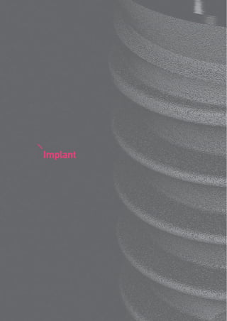 6 I Scientific Evidence 7IMPLANT I
Co., Mortsel, Belgium) system of periapical
radiographs. Measurements were recorded at
the time of surgery, immediate loading, after
3-months of continued loading, and at the last
follow-up (Fig. 2). Marginal bone height was
determined on these images by measuring the
distance from a reference point, defined as the
platform of the implant (Fig. 2), to the most
coronal point of bone-to-implant contact on
both the mesial and distal sides of the implant.
A single value for marginal bone height was
then calculated by obtaining the mean of these
two measurements for each implant.
The definition of implant success was based
on the following clinical and radiologic crite-
ria: 1) absence of clinically detectable implant
mobility, 2) absence of pain or any subjective
sensation, 3) absence of recurrent peri-implant
infection, and 4) absence of continuous radiolu-
cency around the implant.10
Fig. 2. Periapical radiograph was taken at the time of (A) immediate loading and (B) 3-months after continued loading. The platform
(black arrows) was a reference point to measure marginal bone loss. Provsional resin restoration was made by polymethylmethacry-
late that is radiolucent. Therefore, only temporary cylinders are seen (white arrows).
A B
Fig. 1. (A) Two implants (SinusQuickTM
EB, Neobiotech Co., Seoul, Korea) were inserted at #36 and #37 area (black arrows). (B) Prov-
sional restoration (white arrows) was delivered 14 days after implant placement.
A B
INTRODUCTION
Traditionally, implant treatment is based on
a 2-stage protocol with a healing period of 3-6
months during which the implants are sub-
merged to achieve osseointegration.1
Recently,
this clinical suggestion has been challenged.
Numerous practitioners now advocate immedi-
ate or early loading of implants.2
The advan-
tages of immediately loaded implants are clear:
they require shorter treatment periods and al-
low immediate recovery of function and esthet-
ics.3
High success rate of immediately loaded im-
plants in humans was first documented in the
middle 1980s. The 88% cumulative success rate
on 1739 immediately loading implants was sug-
gested.4
The clinical performance and prognosis
of the singlestage surgical protocol are known
to be comparable to the traditional 2-stage
method.5
There are some articles reporting a
cumulative survival rate of 95%, which inves-
tigated immediately loaded single implants.6,7
Results from these studies suggest that imme-
diate loading could achieve equal success rates
as those found in delayed loading.
It is also known as a common claim that treat-
ment with immediate loading improved patient
satisfaction and was cost effective although no
scientific evidence was presented to support.8
However, advantages of early or immediate
loading as mentioned may be offset by an in-
creased risk of implant failure. It was reported
that immediately loaded implants were ap-
proximately 3 times more likely to fail within
1 year of placement.3 Furthermore, there have
been few clinical studies investigating the suc-
cess or failure rates of immediate loading based
on Korean implant systems.
The aim of this preliminary prospective study
was to evaluate the outcome of immediate func-
tional loading in partial edentulism, using Si-
nusQuickTM
EB (Neobiotech Co., Seoul, Korea)
implant system.
MATERIALAND METHODS
Four subjects (2 smokers and 2 non-smokers)
recruited from a population of patients under
routine care at Seoul National Bundang Hos-
pital were enrolled in the study. The patients
were selected according to the following in-
clusion criteria: they were in normal general
health with sufficient bone to allow the place-
ment of implants at least 7 mm length. Pa-
tients with high masticatory or parafunctional
forces were excluded. The mean age of the
subjects was 50.3 years (range from 39 to 65
years), with a gender distribution of 100% men.
Informed written consent was obtained from
all subjects following approved institutional re-
view board guidelines for clinical research.
Surgery was performed under local anesthe-
sia (1 : 100,000 Epinephrine) or conscious in-
travenous sedation with 1% Propofol solution
and Midazolam. After a crestal incision, a mu-
coperiosteal flap was elevated. Implants were
inserted according to the procedures recom-
mended by manufacturers. During the period
from April to October 2009 (range from 2 to 6
months), 15 SinusQuickTM
EB implants were
installed in patients’jaws. Immediate loading
was applied to the implants showing implant
stability quotient (ISQ) and insertion torque
values that were more than 60 and 35 Ncm,
respectively. Immediate loading is defined as
provisional or final implantsupported resto-
ration delivered within 2 weeks.9
Therefore,
provisional implant-supported fixed partial
dentures were delivered within 2 weeks (Fig.
1). The patients were instructed in soft diet and
thorough oral hygiene care. The definite resto-
ration was performed approximately 12 weeks
after implant insertion.
Periapical radiographs were taken using com-
mercially available film holders and a parallel-
ing imaging technique during the investigating
period. In each patient, peri-implant marginal
bone level was evaluated by IMPAX®
(Agfa
 