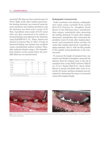 98 I Scientific Evidence 99SINUS I
4. Depth gauge (Fig.5)
A depth gauge is an instrument that measures
the height of residual bone following puncture
with S-reamer. Both ends of the depth gauge
are flat, it can be held against the interior side
of the sinus wall. The depth can be measured
when the depth gauge is inserted and hang on
the sinus inferior wall.
Note that the depth gauge should not be in-
serted more than 1 mm beyond the residual
bone.
5. Bone carrier (Fig.6)
The bone carrier is a tool that can be used to
safety carry bone into the sinus hole.
6. Bone condenser (Fig.7)
A bone condenser is used to fill perforated
holes with bone carried by a bone carrier. A
stopper equal in length to the height of the re-
sidual bone should be used.
The bone condenser includes diameters of
1.0 and 2.2 mm. A small-diameter condenser
should be used for cases involving the insertion
of hard bone or large particles.
7. Bone inserter (Fig. 8)
During bone grafting, bone is inserted into the
hole using a bone carrier. The bone inserter is a
tool that pulls the bone into the sinus. It can be
used safely together with a stopper to prevent
damage to the membrane.
8. Bone spreader (Fig.9)
A bone spreader is a tool that allows safe el-
evation of the membrane by laterally spreading
the inserted bone. Bone spreaders are available
with diameters of 2 mm and 3mm.
A bone spreader should be used after the in-
sertion of bone in volumes greater than 0.3cc.
After a drill stopper equal in length to the
height of residual bone, the bone spreader
is slowly rotated to the left and right. When
the bone material in a volume of 0.2-0.3 cc is
added, the length of the drill stopper should
be increased by 1 mm. This procedure should
be repeated as required. For both vertical and
lateral elevation of the membrane, when re-
sistance is perceived during bone condensing,
spreading should be performed.
Fig. 5. Depth gauge
Fig. 6. Bone carrier
Fig. 7. Bone condenser
Fig. 8. Bone inserter
Fig. 9. Bone spreader
Procedures
The residual bone height of the maxillary1.	
sinus should be measured by preoperative
X-ray.
Stepwisedrillingshouldbestartedtoadepth2.	
of 1 mm less than the measured height. The
final diameter of the hole drilled should be
determined based on bone density.
For safety, a drill stopper 1 mm longer than3.	
the desired depth of drilling should be mea-
sured on the S-reamer.
The diameter of the S-reamer should be se-4.	
lected based on the diameter of the fixture
and the depth of insertion into the sinus
(Table 1).
The inferior wall doesn’t perforate though5.	
the stopper reaches the crestal bone, the
stopper should be replaced by a one size
larger, and drilling should then be repeated.
When perforation is achieved can be deter-6.	
mined. The height of residual bone should
be measured using a depth gauge. The depth
gauge should be inserted carefully along the
lateral wall and hang on the inferior sinus
wall. Thus, the height of residual bone can
be measured accurately. The depth gauge
should not enter the sinus wall by more
than 1 mm.
When perforation of the inferior wall is con-7.	
firmed, the nose should be obstructed and a
nose blow test should be performed to con-
firm membrane perforation. If sinus mem-
brane was not perforated, the bone mate-
rial should be inserted, and the membrane
should be elevated accordingly. When a large
amount of bone is to be inserted, soft bone,
such as a demineralized freeze-dried bone
allograft (DFABA), should first be inserted
relative to the degree of elevation. The mem-
brane can then be safety elevated, and hard
bone can be inserted.
Case Report
(CMI fixation without bone graft)
Fig. 10. The height of residual bone in teeth
#16 and #17 was confirmed to be 8.0 mm.
Following the addition of bone, a wide-body
implant (5.0 X 10 mm) was placed.
Fig. 11. Drilling is performed during flapless sur-
gery using a drill that is 1 mm shorter than the
depth of residual bone.
Fig. 12. In planning for wide-body implant
placement, the hole should be enlarged as
drilling is performed.
Fig. 13. A wide implant is inserted to depth of 3
mm following selection of a 3.2 mm S-reamer
with an 8.0-mm stopper.
 