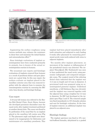122 I Scientific Evidence 123SINUS I
Fig. 4. A. A 46 year old male patient visited at a private dental
clinic. His chief problem was pain on right upper side previous-
ly. Right first premolar had an abscess which was extracted.
Subsequently radiographic image was obtained which re-
vealed that he lost all premolar and molar on both side of up-
per jaw.
Fig.4. B. 10mm, 7mm, 7mm and 8.5mm length implant were
chosen from right first premolar to secondary molar. Alveolar
bone defect was grafted with synthetic bone material on dis-
tal of right first premolar.
Left side was finished with conventional lateral approach sinus
lift and all 13mm implant installation.
Fig.4. C. Final restoration was delivered at two weeks after sur-
gery.
Fig. 5. A and B. One of the post-
operative radiographic image dem-
onstrated that about 3-3.5mm grafted
material was detected on the apex of
implant fixture. Radio-opaque bone
graft material was Osteon®
(Dentium,
Korea).
Fig. 6. A and B. Summer’s osteotome
technique can not achieve a bi-
cortification from inferior border of
sinus floor because inner cortical lining
bone was broken broadly. Compared
with malleting method, this drilling os-
teotome acquired true meaning of bi-
cortification.
Fig. 5. B.
Fig. 6. B.
Corresponding Author : Hyo-Jung Lee, D.D.S., M.S.D.
Department of Periodontology, Section of Dentistry, Seoul National University Bundang
Hospital 300, Gumi-dong, Bundang-gu, Seongnam-si, Gyeonggi-do, 463-707, Korea
E-mail: periolee@gmail.com / Received May 11, 2009 Accepted May 27, 2009
Med Oral Patol Oral Cir Bucal. 2011 Jan 1;16(1):e79-82.
A novel trephine design for sinus lift lateral approach: Case report
Núria Farré-Pagès 1
, Maria-Luisa Augé-Castro 2
, Fernando Alaejos-Algarra 3
,
Javier Mareque-Bueno 4
, Eduard Ferrés-Padró 5
, Federico Hernández-Alfaro 6
1
DDS, Master in Oral Implantology, PhD student
2
MD, DDS, Master in Oral Implantology, A. Professor
3
MD, DDS, PhD Master in Oral Implantology, A. Professor
4
MD, DDS, PhD OMFS, A. Professor
5
MD, DDS, PhD OMFS, Prof. and Head of Department
6
MD, DDS, PhD OMFS, Prof. and Director Master in Oral Implantology
Abstract
Various techniques are described in the literature, either by crestal or lateral approach. Sinus aug-
mentation has a high percentage of success, but presents a number of intraoperative and postopera-
tive complications. The most frequent complication is the Schneiderian membrane perforation with
a percentage of perforations between 11% and 56% according to authors. The aim of this study is
to describe another membrane approach technique for the sinus lateral wall osteotomy that mini-
mizes the risk of Schneiderian membrane perforation. We present a case of a 50 year old patient at-
tended the University Dental Clinic (UDC) of International University of Catalonia for implant and
crown treatment due to the loss of a right maxillary first molar. To insert an implant in position 1.6
a computerized tomography (CT) was requested to determine with greater accuracy the quantity of
residual crestal bone. It showed a height of 5 mm and width of 8 mm. The lateral osteotomy was per-
formed with a (SLA KIT® -Neobiotech) trephine mounted in the same implant handpiece with which
the field for the implant and the implant itself were prepared. It can be concluded that in the case
described, the use of trephine drills of the SLA system mounted in a handpiece allows better access
to lateral approach due to its perpendicular position relative to the sinus wall minimizing the mem-
brane perforation risk.
Key words:
Sinus lift, lateral approach, membrane perforation, trephine drills, dental implant.
 