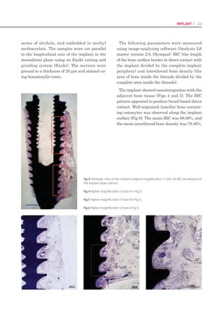 124 I Scientific Evidence 125SINUS I
Introduction
The sinus lift technique was introduced by
Tatum in 1975 and published by Boyne 
James in 1980 (1). This pre-prosthetic surgery
allows bone augmentation in the posterior zone
of atrophic maxilla in pneumatized sinus cases
for implant surgery at the same time as, or af-
ter osseointegration of sinusal graft material.
Various techniques are described in the litera-
ture, either by crestal or lateral approach. The
lateral approach is to perform an osteotomy in
the lateral sinus wall opening a bone window
that allows access to lift the Schneiderian mem-
brane and to place the graft material. Sinus
augmentation has a high percentage of success,
but presents a number of intraoperative com-
plications (membrane perforation, fracture of
the residual alveolar ridge, obstruction of the
maxillary ostium, hemorrhage, and damage to
adjacent dentition), early postoperative com-
plications (hemorrhage, wound dehiscences,
acute infection, exposure of barrier membrane,
graft infection, graft loss and dental implants
failure) and late postoperative complications
(graft loss, implant loss or failure, implant mi-
gration, oroantral fistula, chronic pain, chronic
sinus disease, chronic infection) (2,3). The most
frequent complication is the Schneiderian
membrane perforation with a percentage of
perforations between 11% and 56% according
to authors. The Schneiderian membrane is
composed of periosteum covered by respiratory
epithelium, which is thin, friable and easy to
perforate. The window design, the presence of
maxillary sinus septa, sinus floor irregularities
and a residual ridge of 3 mm or less, increase
the risk of perforation (4,5). Wallace et al. (6)
describe that in most cases, perforation occurs
during the use of rotary instruments for sinus
wall osteotomy, before lifting the membrane.
His study, showed 30% perforations with the
use of rotary instruments and a drill, while
with the use of piezoelectrics there were only 7%
perforations. According to results, Stübinger et
al. (7) who compare the ultrasonic bone cutting
with burs for surgical approach for sinus lift
and bone blocks graft, conclude that ultrasonic
use preserves adjacent soft tissues structures.
Later, Blus et al. (8) in 2008 refers to 3.8%
perforations, 2 out of 53 membranes that were
perforated during the sinus approach with the
application of ultrasonics. The membrane per-
foration can lead to graft material loss, graft
material dispersion leading to bacterial con-
tamination and postoperative infection (9).
The aim of this study is to describe another
membrane approach technique for the sinus
lateral wall osteotomy that minimizes the risk
of Schneiderian membrane perforation us-
ing the surgical instruments from a SLA KIT
–Yield® (Neobiotech) mounted in a dental im-
plant handpiece, and to assess the advantages
and disadvantages offered by the system.
Clinical Case
We present a case of a 50 year old patient at-
tended the University Dental Clinic (UDC) of
International University of Catalonia for im-
plant and crown treatment due to the loss of
a right maxillary first molar. A clinical history
was completed, an intraoral examination made,
and extraoral and intraoral registers (study
cast, frontal and lateral pictures in maxim
intercuspidation, excursives movements and
panoramic radiography) were performed at the
first visit. The patient did not have any medical
nor surgical contraindication to maxillary sub-
antral augmentation. In a radiographic test we
observed a right maxillary sinus pneumatized
with a low bone height. To insert an implant in
position 1.6 a computerized tomography (CT)
was requested to determine with greater ac-
curacy the quantity of residual crestal bone. It
showed a height of 5 mm and width of 8 mm
(Fig. 1).
We carried out a sinus lift and the implant in-
sertion in position 1.6 at the same time to mini-
mize the number of operations on the patient.
Access to the membrane approach was effect-
ed using the SLA KIT –Yield® (Neobiotech) for
sinus lift lateral approach access. This kit has
a guide drill to start the window design and
obtain the correct position so avoiding slips,
then the SL Reamer and/or C Reamer drills
are used. The drills have diameters of 4.5 mm,
5.5 mm and 6.5 mm. The LS Reamer drills
have a height of 2 mm and 3.5 mm and the
C Reamer drills have heights of 1.5 mm and
3 mm. After setting the position with a guide
drill the LS Reamer drill is used to collect bone
chips during osteotomy of the lateral window of
the sinus or the C Reamer drill that allows the
safe osteotomy of the lateral window. The drill
diameter and height is determined depending
on each case. The contact surface of the reamer
drill allows the osteotomy without the risk of
perforating the Schneiderian membrane sinus.
A sterile surgical area was prepared. Surgical
procedure was under a local anesthetic nerve
block in the right upper maxilla, and infiltra-
tive anesthesia in palatal zone at palatal fora-
men level. A crestal incision was made and a
distal vertical discharge. A mucoperiosteal flap
was lifted and a maxillary alveolar process was
revealed. The osteotomy was performed at a
height of 7 mm above the crestal margin with
a trephine mounted in the same implant hand-
piece with which the field for the implant and
the implant itself were prepared. Osteotomy
milling was at 2000 rpm with external irriga-
tion, perpendicular to the sinus wall up to the
sinusal membrane. The contact area of tre-
phine drill permits contact with the membrane
without causing perforation (Fig. 2).
The lateral bone window was removed with
a periosteal elevator and the membrane lifted
with lift instruments from the SLA KIT. After
the insertion of the sinus graft and implant in
1.6 position, the lateral window wall was repo-
sitioned and the surgical incision area was su-
tured with a monofilament suture 4/0. To pre-
vent early postoperative complications of sinus
augmentation, antibiotics and analgesics were
prescribed and the patient was given informa-
tion on postoperative care. The suture was re-
moved one week after surgery. After 7 months
a panoramic radiography image was obtained
(Fig. 3).
Fig. 1. Panoramic projection in the CT of surgical zone.
Fig. 2. Lateral osteotomy.
Fig. 3. Panoramic radiography before second stage.
 