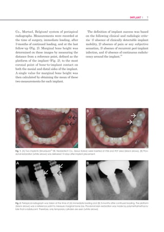 12 I Scientific Evidence 13IMPLANT I
2) 임플란트 식립(Fig. 2)
약 4주간 치유 후 발치와 동일한 방법으로 실험동물을 진
정마취 후 국소마취 하였다. 무치악 치조정 절개로 협설측
전층 판막을 박리하고 치조정을 평탄하게 하여 임플란트
를 식립하기 위한 골폭을 확보한 후, 3 mm 이상의 임플란
트 사이 간격을 두어 마리 당 7개씩 무작위 배정 식립으로
총 14개의 임플란트를 식립하였다. 임플란트 수술용 엔진
(NSK Surgic XT, NSK, Tochigi-ken, Japan)의 출력토
크를 30 Ncm로 설정하였으며, 엔진으로 식립이 완료되지
않은 임플란트는 수동토크렌치(Neobiotech Co., Seoul,
Korea)를 이용하여 collar-thread간의 경계부위가 치조
정과 일치되도록 육안으로 확인하면서 식립하였다. Heal-
ing abutment (ISH404, Neobiotech Co., Seoul, Korea)
를 즉시 체결하고 4-0 흡수성 봉합사(Vicryl®
, Ethicon,
Somerville, NJ, USA)로 봉합하였다.
3) 수술후관리
실험 동물의 발치 및 임플란트 식립 직후와 48시간 후
penicillin G procaine과 penicillin G benzathine (Dea-
sung microbiological labs. co., Seoul, Korea)을 근육
내 주사하였다(1 ml/5 kg). 술후1주간2% chlorhexidine
을 10 cc 시린지에 넣어 하루에 2회 구강 내 소독을 하고 4
주 간격으로 스케일링을 하였으며 유동식 사료를 공급하였
다.
Table 1. Implant fixtures used in this study.
Group N Description
Length
(mm)
Diameter
(mm)
Bevel 7
bevel and
machined surface
7.5 3.5
Bioseal 7
“S”-shaped and
machined surface
7.5 3.5
Figure 1. Design of implant fixtures used in this study: A, Bevel
group; B, Bioseal group.
Figure 2. Surgical procedures. A: Flattening edentulous ridge, B:
Drilling, C: After fixation.
0.15 mm
0.15 mm
0.05 mm
3.5 mm
0.5mm
7.5mm
0.5mm
A
B
C
서론
치과용 골내 임플란트를 이용한 치료는 부분 또는 완전무
치악 환자의 구강기능 회복을 위한 예지성 높은 치료방법
으로 인정받고 있다.1,2
기능적이며 심미적으로 장기간 임
플란트 치료의 성공을 위해서는 여러 가지 요소가 관여하
는데,3
그 중에서도 특히 임플란트 변연골을 보존하고 주변
연조직을 건강하게 유지하는 것이 중요하다.4
초기 변연골 흡수의 원인으로 임플란트 수술 시 골막거
상, 골삭제, 과도한 응력, 세균 침입 및 생물학적 폭경의
침범 등을 들 수 있다.5
수술 시 시행하는 골막거상은 혈액
공급에 영향을 줄 수 있지만, 망상골이 풍부한 경우에는 피
질골 흡수에 미치는 영향은 크지 않다.5
임플란트 식립 드
릴링으로 인한 외상이 초기 변연골 상실의 원인이라고 주
장하기도 하지만,6
2차 수술시 이전보다 골이 증가한 경우
를 종종 확인할 수 있다.5
임플란트 주위골에 과하중이 전
달될 경우 변연골 흡수가 야기되지만,7,8
비교적 약한 하중
또는 점진적인 하중은 오히려 골흡수를 막는다고 보고되고
있다.9-12
세균은 자연치에서는 주변골상실의 근본적인 원
인이지만, 임플란트의 경우에서는 보조적인 인자에 국한되
며 초기 변연골 흡수의 원인으로 보기는 어렵다.13-15
임플란트에서도 골유착을 보호하기 위한 최소한의 연조
직 즉, 생물학적 폭경이 형성될 때까지 변연골 흡수가 일어
난다고 밝혀진바 있으며,16
임플란트에서 생물학적 폭경이
주변조직에 미치는 영향에 대한 많은 연구가 있어 왔다.16-
20
임플란트의 생물학적 폭경은 전체적으로는 안정적으로
존재하지만 시간의 경과에 따라 접합상피 부착은 증가하고
결합조직 부착은 감소하는 특징을 보인다.19,20
생물학적 폭
경은 수직적 길이 외에도 수평적 공간을 포함하여 인접한
임플란트 사이 거리가 3mm 이하일 때는 생물학적 폭경을
확보하기 위해 골흡수가 발생한다고 보고된 바 있다.21
특
히 변연골의 보존을 위해서는 생물학적 폭경을 이루는 구
성요소 중 접합상피보다는 결합조직 부착이 더욱 중요하
다.22
연조직과 경조직의 경계에 위치하는 임플란트 경부의 디
자인은 연조직 반응과 변연골 보존에 영향을 미친다.17,18,22
플랫폼 스위칭은 식립된 임플란트의 플랫폼보다 작은 직경
의 지대주를 연결하는 술식으로서,23,24
염증세포 침윤대를
내측으로 이동시킬 뿐만 아니라 변연골에 가해지는 응력을
감소시켜 변연골 흡수를 감소시킬 수 있는 장점이 있다.25-
27
또한 임플란트 연조직 관통부위의 오목한 디자인이 결합
조직의 두께 증가와 견고한 부착을 가능하게 하며,22
임플
란트 경부의 표면 roughness나 microthread 설계가 변연
골 흡수를 감소시킨다는 보고가 있다.28,29
근자에는 이러한
보고들을 근거로 임플란트 경부가 디자인된 제품들이 임상
에 많이 사용되고 있다.28-30
하지만 임플란트 경부 디자인에 관한 기존 연구들은 비교
한 임플란트의 제조사가 다르거나, 크기뿐만 아니라 경부
이외에 다른 부분의 디자인에서도 어느 정도 차이가 존재
하기 때문에 경부 디자인만의 영향을 파악하는 데는 다소
의 제한점이 있다.17,22,28-31
또한 임플란트 경부 디자인 측
면에 대한 연구에서도28,29
연, 경조직 경계부에 가장 가까
운 임플란트 collar design에 관한 연구는 미흡한 편이다.
이에 본 연구에서는 임플란트 제조사, 크기 및 전체적인
디자인이 동일하지만 collar 부위에 단순한 bevel 형태 또
는 결합조직 부착길이의 증가를 위한“S”자 형태를 갖는 임
플란트를 제작, 이용하여, 임플란트의 collar design이 변
연골 변화와 연조직 반응에 미치는 영향을 동물실험을 통
해 알아보고자 하였다.
연구 재료 및 방법
1. 연구 재료
실험용 임플란트(Neobiotech Co., Seoul, Korea)는
두 가지의 collar 디자인을 가지고 있으며, collar 부위에
bevel만을 가지고 있는 집단을 Bevel 군“, S”자 형태를 가
지고 있는 집단을 Bioseal 군으로 나누었다(Table 1). 나
머지 부위는 internal cone 연결부를 가지는 tapered-
screw 형태로 동일하고 두 군 모두에서 collar 부위는
machined 표면이나 나머지 부위는 resorbable blasting
media (RBM) 표면처리(Ra = 1.2 - 1.5) 되었으며 자세
한 수치 및 형태는 Fig. 1과 같다.
2. 연구 방법
1) 실험 동물의 발치
본 연구에서는 2마리의 건강한 비글견(평균 2세, 평
균 15 kg)이 사용되었으며, 전남대학교 수의과대학 동물
실험 윤리위원회의 승인 하에 진행했다. 수술실은 소독
상태를 유지하였으며 실험동물의 발치는 2% isoflurane
(Isoflurane®
, Choongwae Co. Seoul, Korea)과 oxygen
으로 흡입진정마취 하에 시행했으며 Lactated Ringer’s
solution을 발치 종료 시까지 5 ml/kg/h 속도로 투여하였
고 1:100,000 epinephrine이 포함된 2% lidocaine HCL
(Yu-Han Co., Gunpo, Korea)을 이용하여 하악 편측에
1.8 ml씩 점막에 추가적인 국소침윤마취를 하였다. 양측
의 하악 소구치 및 제 1 대구치를 발거한 후, 4-0 흡수성
봉합사(Vicryl®
, Ethicon, Somerville, NJ, USA)로 봉합
하였다.
 