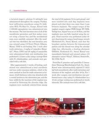 138 I Scientific Evidence 139SINUS I
be explained by the average location of the in-
traosseous arterial branch, which ranges from
16 to 19 mm from the alveolar crest.35
There-
fore, if the superior aspect of the lateral an-
trostomy is less than 16 mm from the alveolar
crest, the artery will not be encountered. SLA
drills decrease injuries to the sinus floor during
membrane elevation, which may lead to a de-
crease in injury to the soft tissue and arteries.
The only reported limitation of piezosurgery is
operative time, which was significantly longer
than when using conventional rotary instru-
ments. These data are in agreement with pre-
vious studies.33,36,37
From a clinical perspective,
the difference in surgical time between both op-
erative procedures is negligible; however, in ar-
eas with a higher bone structure or thickness,
an osteotomy via piezoelectric surgery could
take up to five times longer than conventional
rotary instruments.33
In this study, SLA tre-
phine drills reduced operative time compared
to conventional rotary instruments (P  .001).
Some studies showed that using piezosurgery
in sinus elevation procedures decreases postop-
erative discomfort.24,38
Moreover, in an in vivo
experimental model, the wound-healing re-
sponse was evaluated following osteotomy with
piezosurgery and diamond or carbide burs. The
results, while acknowledging the small sample
size, indicated a more favorable osseous re-
sponse with piezosurgery when compared with
diamond or carbide burs.39
In this study, it was
found that, compared to carbide burs, using
trephine drills in sinus elevation procedures de-
creases postsurgical pain. This difference was
not significant, possibly because of the small
sample.
CONCLUSION
This study compared SLA KIT trephine drills
to conventional rotary instrumentation with
the described technique in sinus elevation pro-
cedures. Advantages of the SLA drills include
reduced surgical time and lower risk for perfo-
ration of the sinus membrane. In addition, SLA
drills are much less expensive than piezoelec-
tric devices, and they perform sinus elevation
more quickly than conventional rotary instru-
ments. No difference was found in postopera-
tive pain scores. Further studies are needed to
compare piezoelectric devices and SLA trephine
drill techniques in sinus elevation procedures.
ACKNOWLEDGMENTS
The authors reported no conflicts of interest related
to this study.
REFERENCES
Lekholm U. Osseointegrated implants in the treat-1.	
ment of partially edentulous jaws: A prospective
5-year multicenter study. Int J Oral Maxillofac Im-
plants 1994;9:627–635.
Lazzara R, Siddiqui AA, Binon P, et al. Retrospec-2.	
tive multicenter analysis of 3i endosseous dental
implants placed over a five-year period. Clin Oral
Implants Res 1996;7:73–83.
Van der Bergh JPA, ten Bruggenkate CM, Disch3.	
FJM, Tuinzing DB. Anatomical aspects of sinus floor
elevation. Clin Oral Implants Res 2000;11:256–
265.
Sharan A, Madjar D. Maxillary sinus pneumatiza-4.	
tion following extractions: A radiographic study.
Int J Oral Maxillofac Implants 2008;23:48–56.
Albrektsson T, Zarb GA, Worthington P, Eriksson AR.5.	
The long-term efficacy of currently used dental
implants. A review and proposed criteria of suc-
cess. Int J Oral Maxillofac Implants 1986;1:11–25.
Jemt T, Lekholm U. Oral implant treatment in pos-6.	
terior partially edentulous jaws: A 5-year follow-up
report. Int J Oral Maxillofac Implants 1993;8:635–
640.
Raghoebar GM, Timmenga NM, Reintsema H,7.	
Stegenga B, Vissink A. Maxillary bone grafting for
insertion of endosseous implants: Results after 12–
124 months. Clin Oral Implants Res 2001;12:279–
286.
Nevins M, Langer B. The successful application of8.	
osseointegrated implants to the posterior jaw: A
long-term retrospective study. Int J Oral Maxillo-
fac Implants 1993;8:428–432.
Tatum H. Maxillary and sinus implant reconstruc-9.	
tions. Dent Clin North Am 1986;30:207–229.
Boyne P, James RA. Grafting of the maxillary sinus10.	
floor with autogenous marrow and bone. J Oral
Surg 1980;38:613–616.
Zijderveld SA, van den Bergh JP, Schulten EA, ten11.	
Bruggenkate CM. Anatomical and surgical find-
ings and complications in 100 consecutive maxil-
lary sinus floor elevation procedures. J Oral Maxil-
lofac Surg 2008;66:1426–1438.
Garg AK, Quinones CR. Augmentation of the12.	
maxillary sinus: A surgical technique. Pract Perio-
dontics Aesthet Dent 1997;9:211–219.
Raghoebar GM, Batenburg RH, Timmenga NM,13.	
Vissink A, Reintsema H. Morbidity and complica-
tions of bone grafting of the floor of the maxillary
sinus for the placement of endosseous implants.
Mund Kiefer Gesichtschir 1999;3:65–69.
Ardekian L, Oved-Peleg E, Mactei EE, Peled M.14.	
The clinical significance of sinus membrane per-
foration during augmentation of the maxillary si-
nus. J Oral Maxillofac Surg 2006;64:277–282.
Galli SKD, Lebowitz RA, Giacchi RJ, Glickman R,15.	
Jacobs JB. Chronic sinusitis complicating sinus lift
surgery. Am J Rhinol 2001;15:181–186.
Karabuda C, Arisan V, Özyuvaci H. Effects of sinus16.	
membrane perforations on the success of dental
implants placed in the augmented sinus. J Perio-
dontol 2006;77:1991–1997.
Lifshey FM, Kang B. A simple method of bar-17.	
rier membrane fixation for large sinus membrane
tears. J Oral Maxillofac Surg 2009;67: 1937–1940.
Pikos M. Maxillary sinus membrane repair: Report18.	
of a technique for large perforations. Implant
Dent 1999;8:29–34.
Proussaefs P, Lozada J, Kim J, Rohrer MD. Repair19.	
of the perforated sinus membrane with a resorb-
able collagen membrane: A human study. Int J
Oral Maxillofac Implants 2004;19:413–420.
Vlassis JM, Fugazzotto PA. A classification system20.	
for sinus membrane perforations during augmen-
tation procedures with options for repair. J Perio-
dontol 1999;70:692–699.
Vercellotti T, De Paoli S, Nevins M. The piezoelec-21.	
tric bony window osteotomy and sinus mem-
brane elevation: Introduction of a new tech-
nique for simplification of the sinus augmentation
procedure. Int J Periodontics Restorative Dent
2001;21:561–567.
Wallace SS, Mazor Z, Froum SJ, Cho SC, Tarnow22.	
DP. Schneiderian membrane perforation rate
during sinus elevation using piezosurgery: Clinical
results of 100 consecutive cases. Int J Periodontics
Restorative Dent 2007;27:413–419.
Blus C, Szmukler-Moncler S, Salama M, Salama H,23.	
Garber D. Sinus bone grafting procedures using
ultrasonic bone surgery: 5-year experience. Int J
Periodontics Restorative Dent 2008;28:221–229.
Rickert D, Vissink A, Slater JJRH, Meijer HJA, Rag-24.	
hoebar GM. Comparison between conventional
and piezoelectric surgical tools for maxillary si-
nus floor elevation. A randomized controlled
clinical trial. Clin Implant Dent Relat Res 2013
Apr;15(2):297–302.
Emtiaz S, Caramês JM, Pragosa A. An alternative25.	
sinus floor elevation procedure: Trephine osteoto-
my. Implant Dent 2006;15:171–177.
Farré-Pagés N, Augé-Castro ML, Alaejos-Algarra26.	
F, Mareque-Bueno J, Ferrés-Padró E, Hernández-
Alfaro F. A novel trephine design for sinus lift lat-
eral approach. Case report. Med Oral Patol Oral
Cir Bucal 2011;16:79–82.
Cawood JI, Howell RA. A classification of edentu-27.	
lous jaws. Int J Oral Maxillofac Surg 1988;17:232–
236.
Oh E, Kraut RA. Effect of sinus membrane per-28.	
foration on dental implant integration: A retro-
spective study on 128 patients. Implant Dent
2011;20:13–19.
Neiva RF, Gapski R, Wang HL. Morphometric anal-29.	
ysis of implant-related anatomy in Caucasian
skulls. J Periodontol 2004;75:1061–1067.
Toscano NJ, Holtzclaw D, Rosen PS. The effect of30.	
 