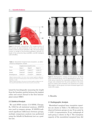 142 I Scientific Evidence 143GBR I
Oral Diseases (2013) doi:10.1111/odi.12109
The effects of ErhBMP-2-/EGCG-coated BCP bone
substitute on dehiscence around dental implants in dogs
Y-S Shin1
, J-Y Seo2
, S-H Oh3
, J-H Kim2
, S-T Kim4
, Y-B Park2
, H-S Moon2
1
Department of Conservative Dentistry, Oral Science Research Center, Yonsei University College of Dentistry, Seoul;
2
Department of Prosthodontics, Yonsei University College of Dentistry, Seoul; 3
Department of Dental Biomaterials, Insti-
tute of Biomaterials-Implant, Wonkwang University School of Dentistry, Iksan; 4
Department of Periodontology, Dental
Research Institute, Seoul National University School of Dentistry, Seoul, Korea
OBJECTIVES:
The purpose was to evaluate the effect of Escherichia coli-derived recombinant human bone mor-
phogenetic protein-2 (ErhBMP-2)-/epigallocatechin-3-gallate (EGCG)-coated biphasic calcium phos-
phate (BCP) and titanium barrier membrane on dehiscence defects in dogs.
MATERIALS AND METHODS:
In five mongrel dogs, the dehiscence bony defects around dental implants were surgically created
and in total three implants were placed at edentulous ridge of which teeth had been extracted 12
weeks before. For the control group, BCP was applied to the dehiscence defect. For experimental
groups, ErhBMP-2-coated BCP and ErhBMP-2-/EGCGcoated BCP were applied. The newly designed
titanium barrier membrane was used to apply all the defects. The defects were evaluated histologi-
cally and histometrically after 12 weeks. The comparative statistics of the groups were obtained
through Kruskal–Wallis test.
RESULTS:
In bone-to-implant contact (BIC), bone density (BD), bone regeneration height (BRH), and bone
mineralization apposition rate (BMAR), differences among groups were not found. ErhBMP-2/EGCG
group appeared to have higher value. In fluorescence analysis, bone remodeling around graft mate-
rial was more active in the ErhBMP-2/EGCG group.
CONCLUSION:
Within the limit of this study, it is reasonable to assume that BMP-2-/EGCG-coated biphasic BCP
and the newly designed titanium membrane were more beneficial in dehiscence defect healing with
increased bone remodeling.
Keywords:
GBR; biphasic calcium phosphate; dehiscence defect; epigallocatechin-3-gallate; ErhBMP-2; tita-
nium barrier membrane
Introduction
The success rate of guided bone regeneration
(GBR) procedure is diversely reported from
79% to 100%, and it has been greatly affected
by barrier membranes and graft materials
(Hammerle et al, 2002). Membrane induces
selective cell proliferation and maintains space
for new bone to be regenerated (Rosen and
Reynolds, 2001). Nonresorbable membrane like
titanium mesh is superior to resorbable ones
in maintaining the space and in keeping a low
incidence of degradation by immune reaction
(Hammerle et al, 2002). However, when non-
resorbable membranes are clinically used for
GBR procedure, additional surgery for mem-
brane removal is needed. In addition, when the
membrane is exposed, infection and inflamma-
tory reaction might jeopardize the defect even
worse than without GBR.
Graft material not only retains the space but
also prevents the formation of empty space un-
der the membrane and consequently contrib-
utes to the formation and stabilization of the
blood clot. In addition, it could reduce the fine
movement of the membrane and promotes the
formation of new bone (Jovanovic and Nevins,
1995). Biphasic calcium phosphate (BCP) is one
of alloplastic bone substitutes, which consists
of hydroxyapatite (HA) and b-tricalcium phos-
phate (TCP), and has a similar structure with
human bone. As the ratio of b-TCP gets higher,
the resorption rate becomes higher accordingly,
whereas as the ratio of HA gets higher, the
resorption rate becomes lower accordingly as
well. It is revealed that the overall resorption
rate is regulated according to their proper ra-
tio. Thus, BCP bone substitute consisting of HA
and b-TCP in the ratio of 7:3 was used to maxi-
mize the osteoconductive effect since this ratio
showed good results in previous studies (Bae et
al, 2010; Kim et al, 2011b).
Many surface treatments have been tested
to improve osteoinductive effect on BCP (Zhu
et al, 2009). Rh-BMP is a growth factor, which
is osteoinductive and also differentiates mes-
enchymal stem cell into osteoblastic cells to
increase new bone formation (Jung et al, 2003).
As watersoluble osteoinductive proteins such as
BMP diffuse rapidly when applied to the trans-
plant area directly, a carrier system is needed
to make it work on the local spot continuously
(Jung et al, 2011). Collagen has been used clini-
cally and experimentally as a BMP carrier and
has made a good result in new bone formation
(Kim et al, 2011a). However, it has failed to
provide sufficient space for bone regeneration
when applied to the large bony defect (Jung et
al, 2011). Therefore, BCP could be considered
as a better carrier than collagen (Kim et al,
2011a). The method of putting a carrier into
the solution diluted with osteoinductive protein
presents a difficulty in manipulating the flow
and in keeping the accurate concentration (Park
et al, 2011). For these reasons, BCP coated with
rhBMP-2 could be better than BCP moistened
with diluted rhBMP-2.
Escherichia coli-derived recombinant human
bone morphogenetic protein-2 (ErhBMP-2) was
made to overcome difficulties in making rhB-
MP-2. A new production method in which BMP
gene is inserted into Escherichia coli (E. coli)
was introduced, so that BMP can be obtained
much more easily with a cheaper cost (Vallejo
et al, 2002). ErhBMP-2 showed more adipose
tissue in bone matrix and bone formations than
CrhBMP-2. In the previous study by Kim et
al (2011a), more bone formation was shown in
BCP group that was coated with ErhBMP-2
than the group with no surface treatment.
Of various osteoinductive agents, epigallocat-
echin-3-gallate (EGCG) reduces the fat content
in the blood and enhances the immune reac-
tion as well as has a therapeutic efficacy on
several diseases including vascular diseases,
diabetes, allergy, cancer, and obesity (Chacko et
 