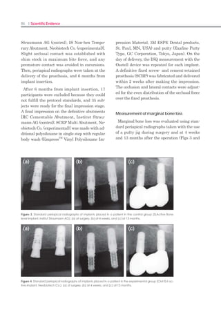 166 I Scientific Evidence 167Restoration I
multiunit implant-supported prosthesis to
overcome the disadvantages of both types of
prostheses.
The Principle and Structure of Screw-
and Cement-Retained Prostheses
A screw- and cement-retained multiunit im-
plantsupported prosthesis (SCRP) is a new
concept for an implant restorative system
and incorporates the advantages of both the
screw- and cement-retained approaches. The
prostheses of the SCRP system have achieved
extraorally. The finished one-piece prosthesis is
a passively fitting screwretained prosthesis.
SCRPAbutment
Conventional cementable abutments with ex-
ternal hex connections can be used for both sin-
gle- and multiunit implant restorations when
implants are placed in parallel. However, hex
abutments on nonparallel implants are not re-
trievable because of the undercuts created be-
tween the angled implants. Nonhex abutments
should be used in such cases, but they cannot
be repositioned after preparation without a
repositioning jig. Nonhex abutments, however,
sometimes cannot be repositioned if the jig is
not fit precisely or if the seating is disturbed by
the surrounding gingiva.
A specially designed prepared abutment
called an SCRP abutment (Fig 1) is unique in
having both hex and nonhex components in one
cementable abutment. The lower half of the
hex portion has a nonhex figure. The upper hex
(engaging) portion of the abutment is designed
to allow for each prepared abutment to be re-
connected to its corresponding implant without
a repositioning jig in the mouth. The lower
nonhex portion is designed for retrievability of
the SCRP after cementing the multiunit super-
structure to the abutments intraorally. Unlike
conventional hex abutments, the SCRP abut-
ments allow the entire superstructure to be
retrieved even if the implants are not parallel
(Figs 3 and 4). This is possible because of the
special structural design of the SCRP abut-
ment, which provides spaces to compensate for
the undercuts created between the hex parts of
the nonparallel implants.
The Clinical Pros and Cons of SCRP
not only a passive fit through using a cement,
but also retrievability, if needed, through the
screw holes on the occlusal surfaces. The SCRP
system is composed of specially designed abut-
ments and a cement-retained prosthesis with
the screw holes on the occlusal surfaces (Fig 1).
After the prepared abutments are repositioned
individually by their hex part and attached to
the implants, the prosthesis is cemented over
the abutments with a definitive cement. The
abutment-superstructure unit is removed from
the mouth by unscrewing the abutment screws
through the holes (Fig 2). A clinician can then
remove the excess cement around the abut-
ments and polish any ill-fitting crown margins
With the SCRP system, the prosthetic super-
structure is retained with any definitive resin
cement, which can compensate for minor dis-
crepancies created during fabrication processes.
As a result, it is possible to achieve a passive
fit even in long-span prostheses without cut-
ting and soldering. The prosthesis of the SCRP
system is retrievable after permanent cementa-
tion, so a clinician can unscrew and retighten
the entire superstructure as needed for repair,
maintenance, or the removal of excess cement
extraorally. Furthermore, this retrievability
makes it possible to use a definitive cement
instead of a temporary cement. Lastly, in cases
with a limited interarch distance, a longer
abutment with a deep subgingival margin can
be used because it can be retrieved for extraoral
cleaning and repair.
As with conventional screw-retained prosthe-
ses, the presence of screw holes on the occlusal
surface can affect the stable occlusion and es-
thetic component of the SCRP prosthesis. Since
the SCRP is cement-retained, cement washout
is inevitable in the long term even if a defini-
tive cement is used. Therefore, it is critical for
the success of the SCRP system to establish the
maximum retention form of the abutment and
select a definitive cement with a high strength.
Conclusions
The SCRP system is a new concept for an im-
plant restorative system that can easily obtain
a passive fit and retrievability. The SCRP abut-
ment with both hex and nonhex components in
one allows repositioning of the abutment and
retrievability of the prosthesis. The SCRP sys-
tem simplifies implant treatment procedures
and eliminates the difficulty of removing excess
cement.
Acknowledgments
Fig 2 Retrieved SCRP prosthesis. The abut-
ment-superstructure unit can be removed
from the mouth after cementation by
unscrewing the abutment screws through
the holes. The excess cement around the
abutments and any ill-fitting crown mar-
gins can also be removed and polished
extraorally.
Fig 1 The components of the SCRP sys-
tem. (a) SCRP is composed of specially
designed abutments (SCRP abutments)
and a cement-retained prosthesis with the
screw holes on the occlusal surfaces. (b)
This abutment has both hex and nonhex
configurations, which satisfies two func-
tions, repositioning of abutment and re-
trievability of SCRP.
Fig 3 Conventional cementable abut-
ments with hex connections: For conven-
tional cementable abutments that possess
a totally hex-type engagement, the pros-
thesis-abutment unit cannot be retrieved
from the implants because of undercuts
created from the hex parts of the nonpar-
allel implants.
Fig 4 Schematic image of retrievable mul-
tiunit SCRP. Even for the angled implants,
any multiunit SCRP can be retrieved due
to the nonhex part of the abutments,
which are designed to compensate for
most of undercuts created from the path
of insertion.
a b
Screw hole
Crown
Cement space
SCRP abutment
Abutment screw
 