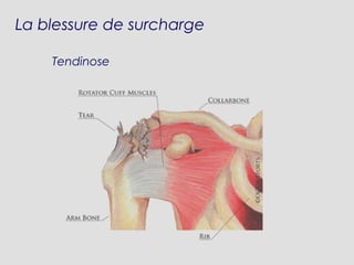 Tendinose
La blessure de surcharge
 