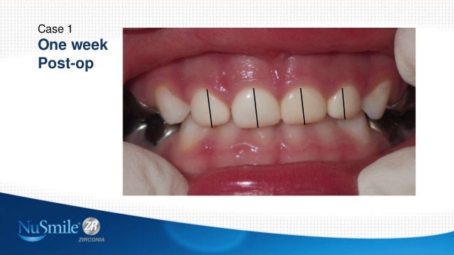 zirconia crowns how polish to up date Pediatric Zirconia Crowns: to zirconia crowns how polish to up date Pediatric Zirconia Crowns: to