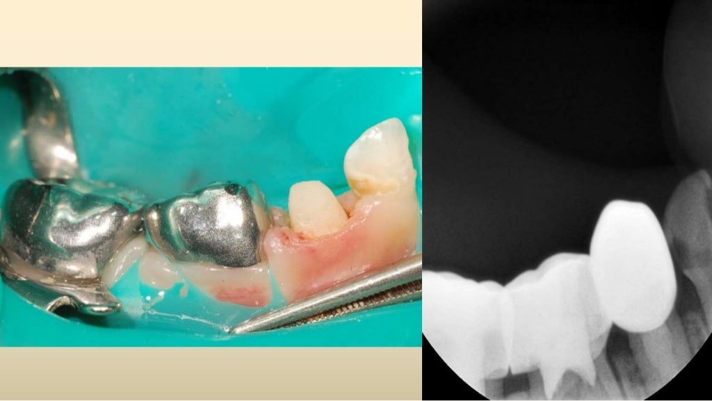 Pediatric Zirconia Crowns uptodate