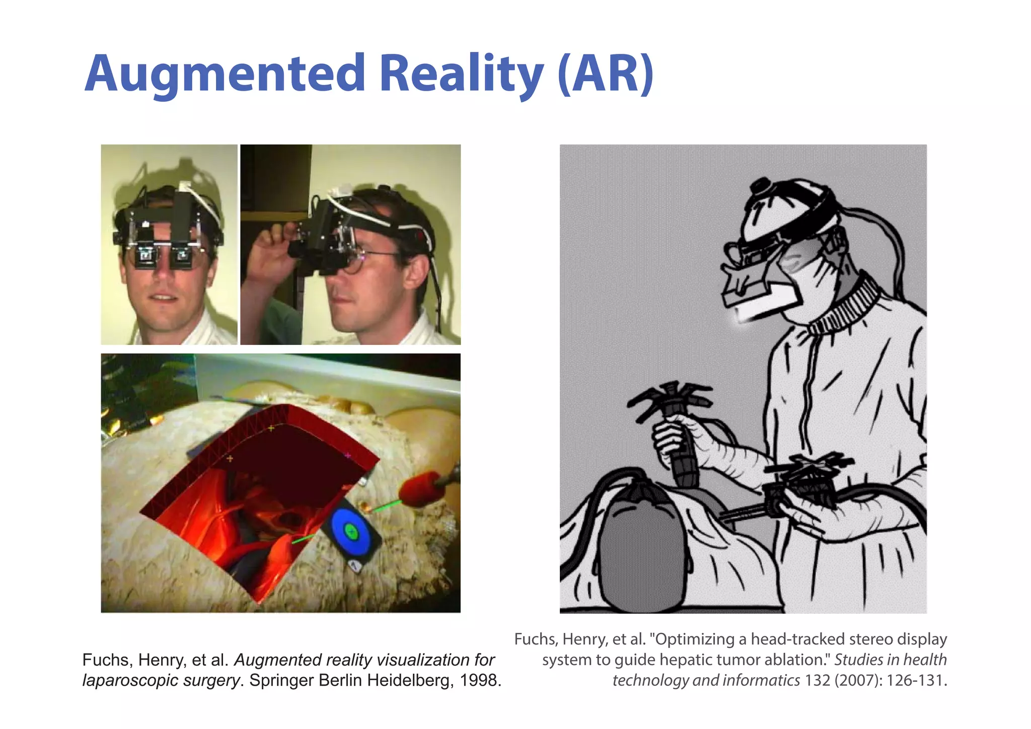 Fuchs, Henry, et al. "Optimizing a head-tracked stereo display
system to guide hepatic tumor ablation." Studies in health
technology and informatics 132 (2007): 126-131.
Augmented Reality (AR)
Fuchs, Henry, et al. Augmented reality visualization for
laparoscopic surgery. Springer Berlin Heidelberg, 1998.
 
