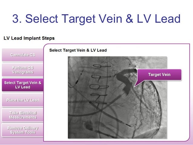 LV Lead Implantation Tools: Choices of LV Leads