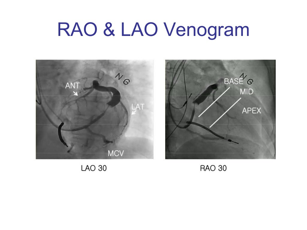 LV Lead Implantation Tools Choices of LV Leads