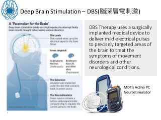 Deep Brain Stimulation – DBS(腦深層電刺激)
1
DBS Therapy uses a surgically
implanted medical device to
deliver mild electrical pulses
to precisely targeted areas of
the brain to treat the
symptoms of movement
disorders and other
neurological conditions.
MDT’s Activa PC
Neurostimulator
 