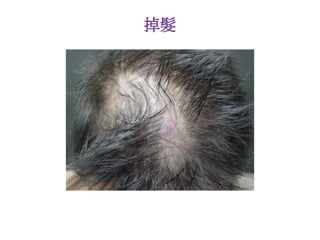 掉髮
 