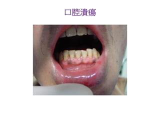 口腔潰瘍
 