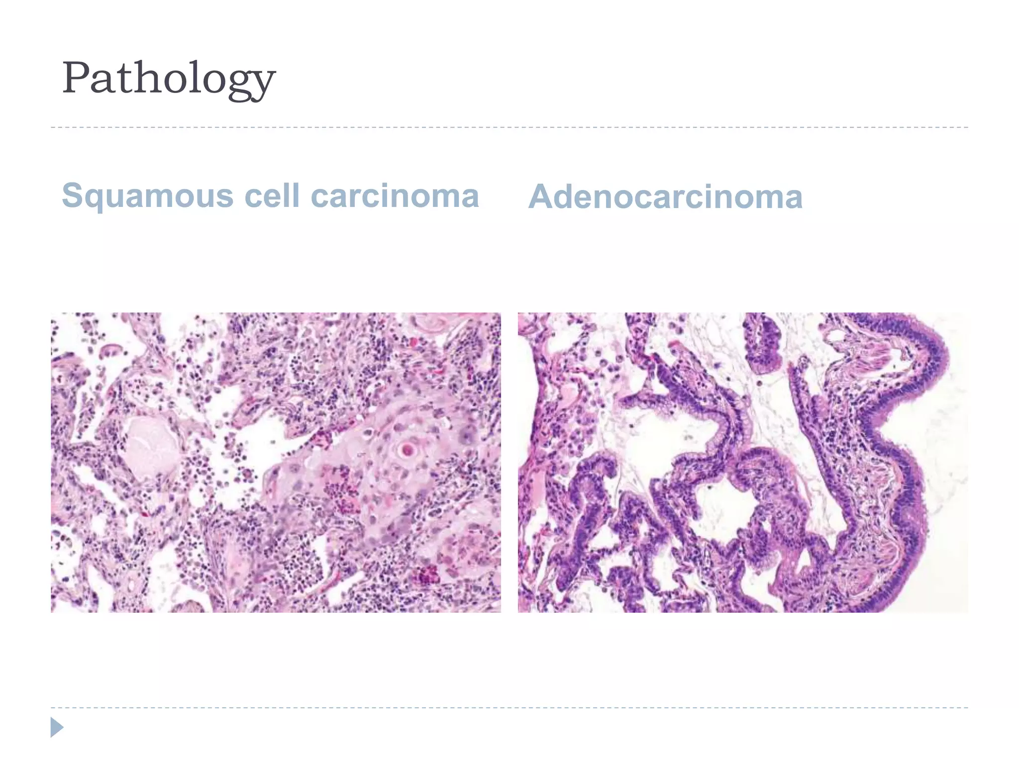 Pathology
Squamous cell carcinoma Adenocarcinoma