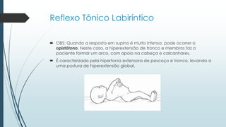  OBS: Quando a resposta em supino é muito intensa, pode ocorrer o
opistótono. Neste caso, a hiperextensão de tronco e membros faz o
paciente formar um arco, com apoio na cabeça e calcanhares.
 É caracterizado pela hipertonia extensora de pescoço e tronco, levando a
uma postura de hiperextensão global.
Reflexo Tônico Labiríntico
 