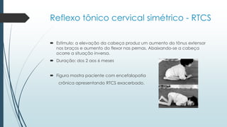 Estímulo: a elevação da cabeça produz um aumento do tônus extensor
nos braços e aumento do flexor nas pernas. Abaixando-se a cabeça
ocorre a situação inversa.
 Duração: dos 2 aos 6 meses
 Figura mostra paciente com encefalopatia
crônica apresentando RTCS exacerbado.
Reflexo tônico cervical simétrico - RTCS
 