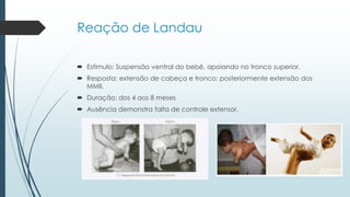 Reação de Landau
 Estímulo: Suspensão ventral do bebê, apoiando no tronco superior.
 Resposta: extensão de cabeça e tronco; posteriormente extensão dos
MMII.
 Duração: dos 4 aos 8 meses
 Ausência demonstra falta de controle extensor.
 