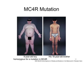 MC4R Mutation
32
2003 NEJM Clinical Spectrum of Obesity and Mutations in the Melanocortin 4 Receptor Gene
9-year-old boy
homozygous for a mutation in MC4R
His 16-year-old brother
 