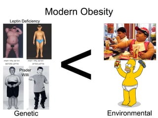 Modern Obesity
Genetic Environmental
Prader
Willi
Leptin Deficiency
 