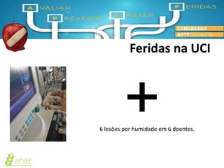 6 lesões por humidade em 6 doentes.
+
Feridas na UCI
 