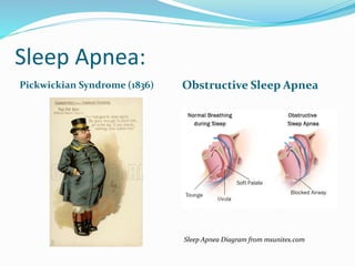 Sleep Apnea:
Pickwickian Syndrome (1836) Obstructive Sleep Apnea
Sleep Apnea Diagram from msunites.com
 