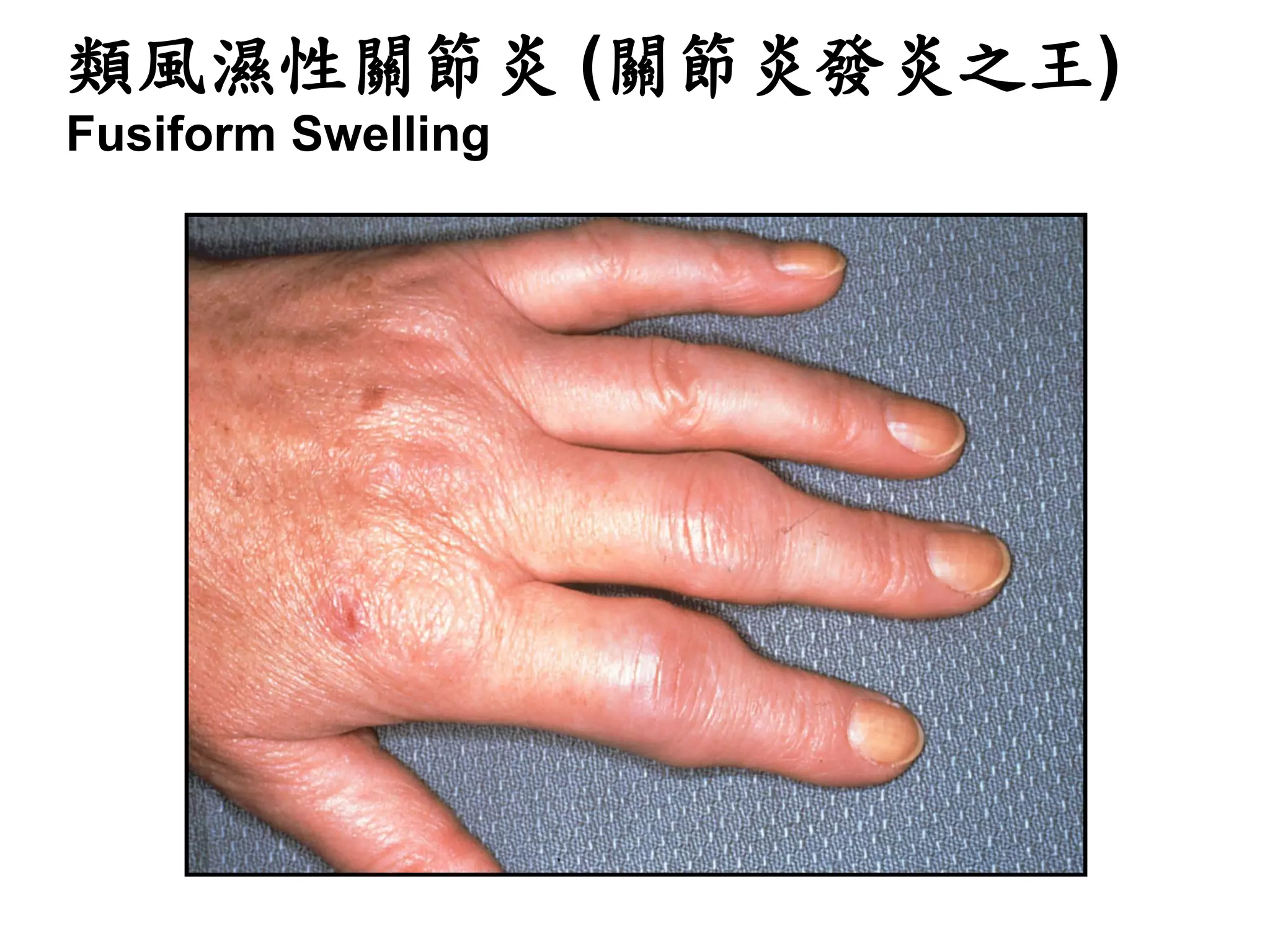 類風濕性關節炎面面觀| PDF