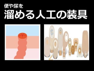 便や尿を
溜める⼈⼯の装具
 