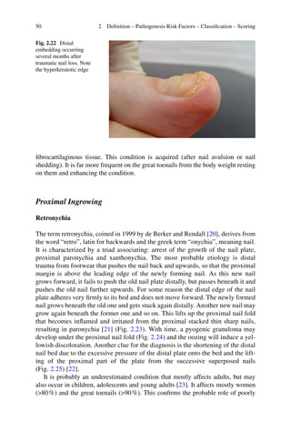 2016 book management of ingrowing nails | PDF