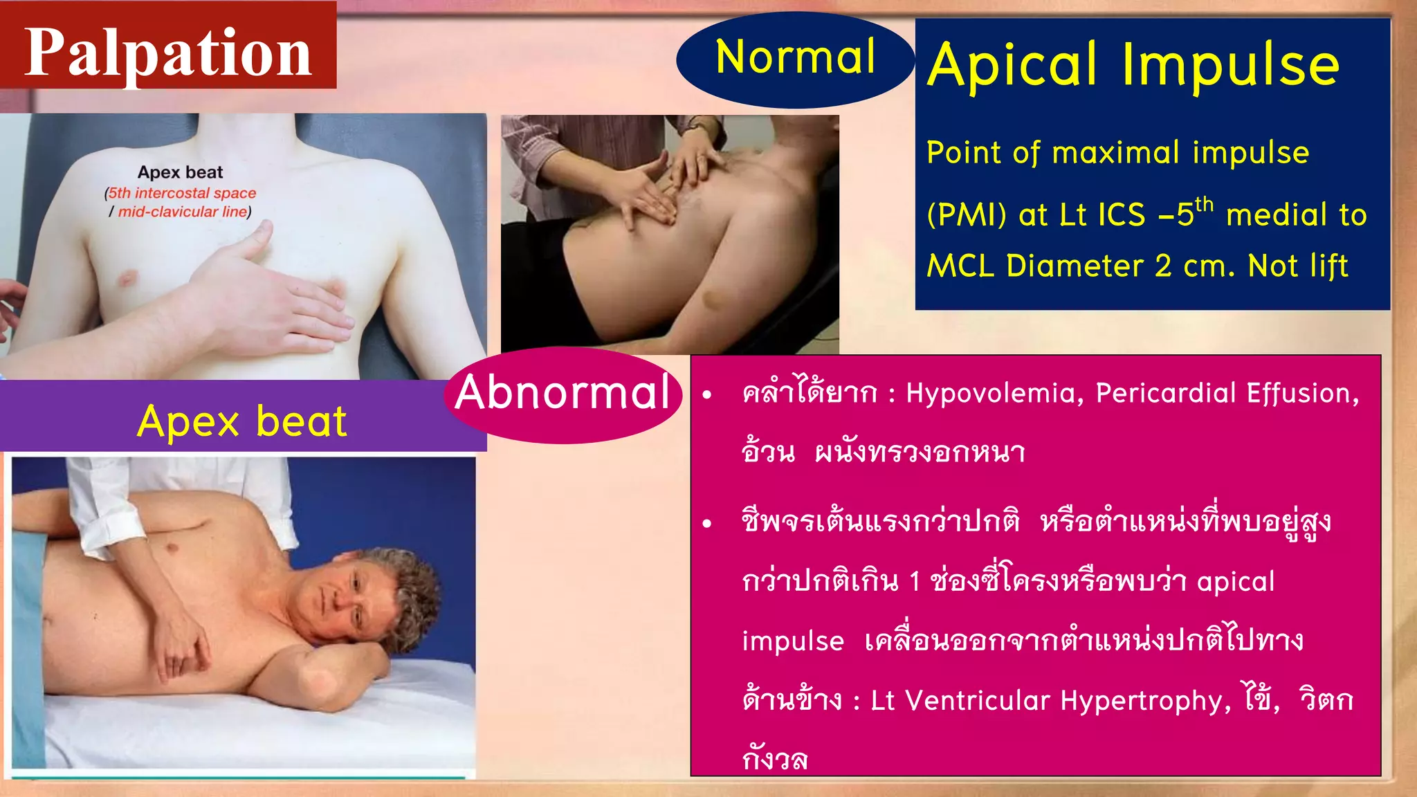 Apex beat
Palpation Apical Impulse
Point of maximal impulse
(PMI) at Lt ICS -5th medial to
MCL Diameter 2 cm. Not lift
Normal
• คลาได้ยาก : Hypovolemia, Pericardial Effusion,
อ้วน ผนังทรวงอกหนา
• ชีพจรเต้นแรงกว่าปกติ หรือตาแหน่งที่พบอยู่สูง
กว่าปกติเกิน 1 ช่องซี่โครงหรือพบว่า apical
impulse เคลื่อนออกจากตาแหน่งปกติไปทาง
ด้านข้าง : Lt Ventricular Hypertrophy, ไข้, วิตก
กังวล
Abnormal
 