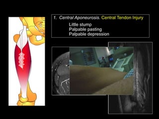 Ramon Balius - Quadriceps Muscle Injuries Diagnosis | PPT