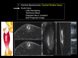 Ramon Balius - Quadriceps Muscle Injuries Diagnosis | PPT