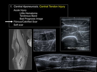 Ramon Balius - Quadriceps Muscle Injuries Diagnosis | PPT