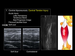 Ramon Balius - Quadriceps Muscle Injuries Diagnosis | PPT