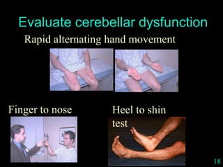 18
Evaluate cerebellar dysfunction
Rapid alternating hand movement
Heel to shin
test
Finger to nose
 